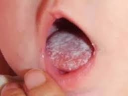 Ulser mulut kanak kanak
