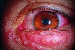 Virus Herpes Pada Mata