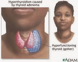 Signs and symptoms, Causes, Types Of Goiter | Tips Curing Disease