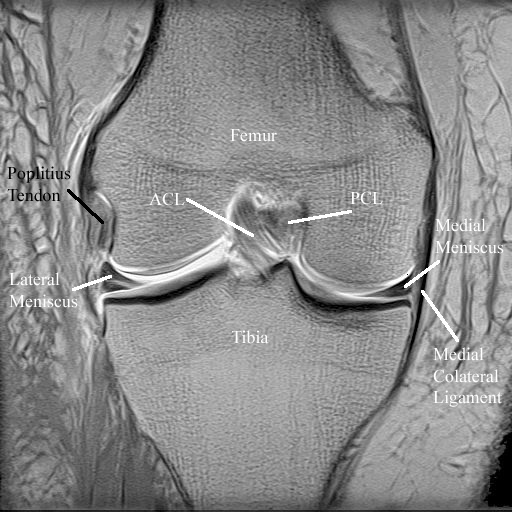 Radiology Anatomy Images Poplitius tendon in coronal knee joint MRI