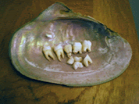 wisdom teeth