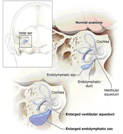 المدونة الطبية د.فهيد سالم السبيعي LABYRINTHINE FISTULA