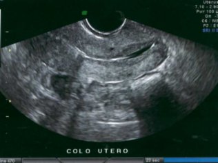 Transvaginal exame
