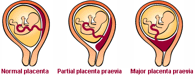 Our beautiful life ..: Placenta Praevia