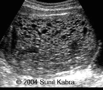 ON - RADIOLOGY: Molar pregnancy....snow white appearance on ultrasound