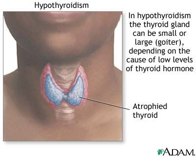 Causes and thyroids