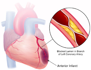 Nursing Assessment for Acute Myocardial Infarction (AMI) - Secondary