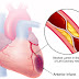 Nursing Assessment for Acute Myocardial Infarction (AMI) - Secondary