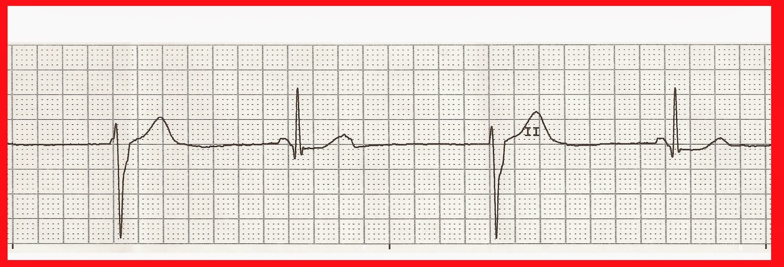 Natural Cure For Tachycardia Natural Cure For Tachycardia