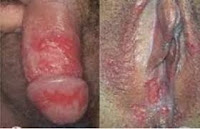 Obat Kencing Nanah Apa Obat Kencing Nanah Apa