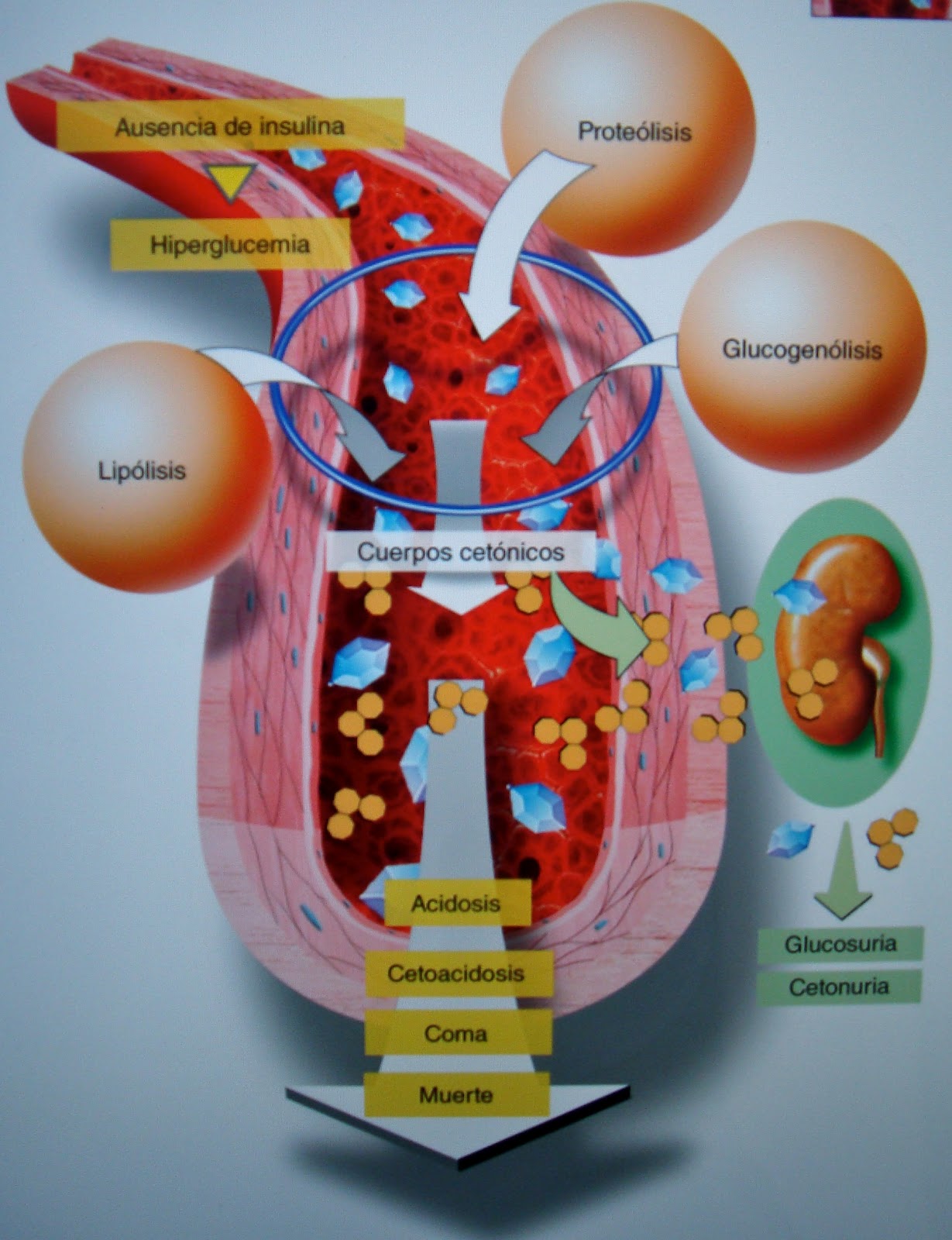 Cetoacidosis diabética | Casa del diabético Vidabetic Cetoacidosis diabética | Casa del diabético Vidabetic