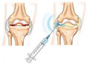 artrose da anca cirurgia