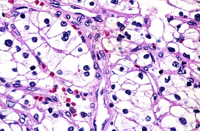 imagen Carcinoma cenal de células claras