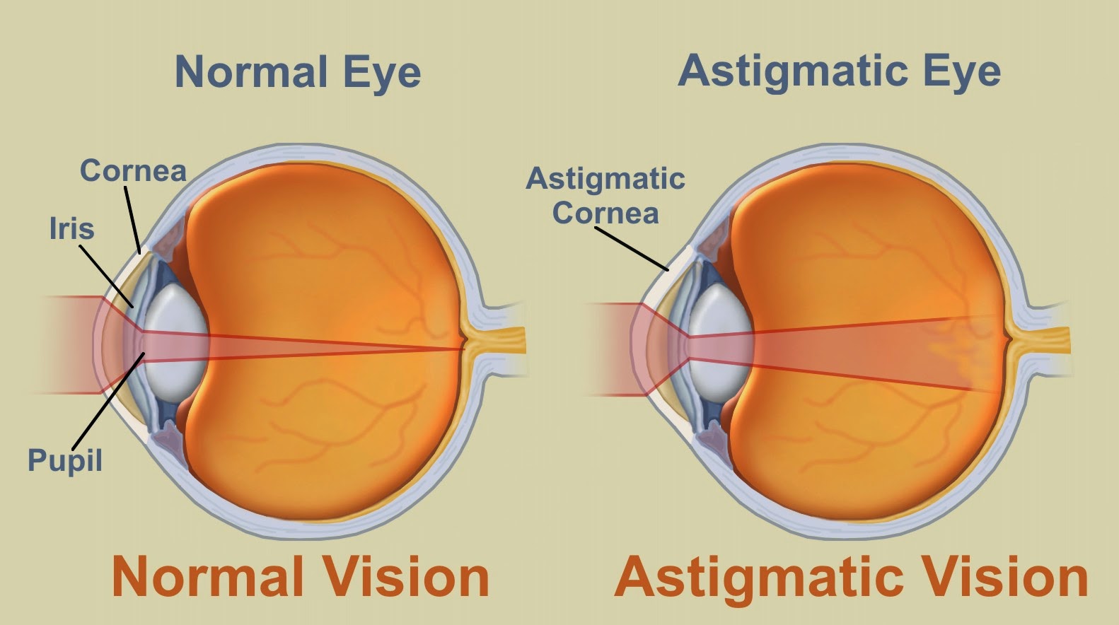 http://www.krishnaeyecentre.com/lasik.php