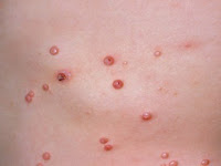 MOLUSCO CONTAGIOSO, O QUE É, TRATAMENTO, DST, TEM CURA, PREVENÇÃO, POMADA, TRATAMENTO NATURAL MOLUSCO CONTAGIOSO, O QUE É, TRATAMENTO, DST, TEM CURA, PREVENÇÃO, POMADA, TRATAMENTO NATURAL