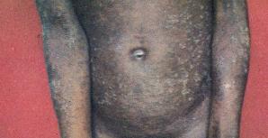 Norwegian Scabies photo is taken from book