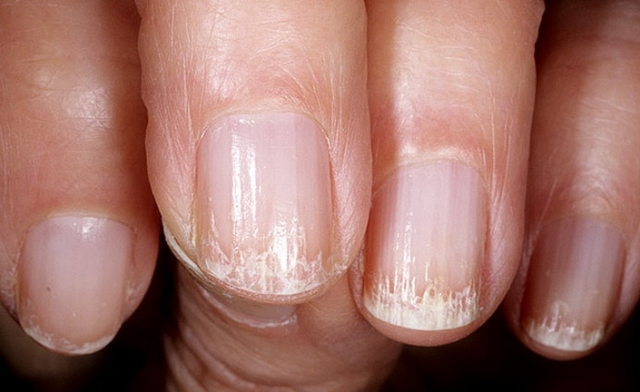 A la psoriasis no es posible hay unos huevos