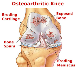 What is Arthritis or Osteoarthritis?