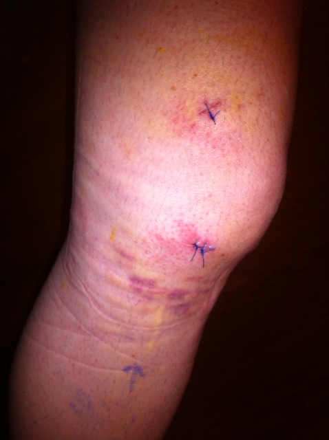Knee+Replacement+Surgery+Scar+Tissue Scar Tissue From Knee Surgery http://www.pic2fly.com/Scar+Tissuein ...