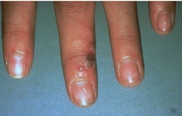 Herpes Simplex Virus - HSV Herpes Simplex Virus - HSV