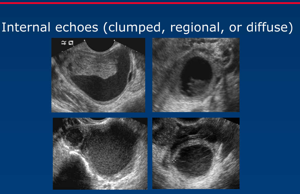 rsna hemorrhagic ovarian cyst