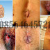 Obat Salep Anti Radang atau Inflamasi Benjolan Wasir thumbnail