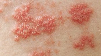 Penyakit Herpes Labialis