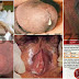 Obat Oral Kemaluan Keluar Nanah Selain AZITHROMYCIN 500 MG thumbnail