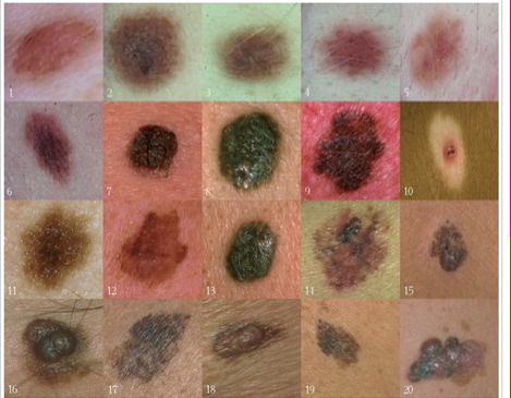 abcd of moles abcd of moles