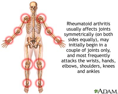 Juvenile Arthritis Causes