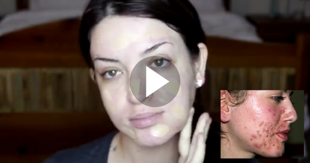 Party Makeup Tutorial For Acne Skins - How Hide Acne With ...