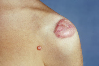Apa Itu Keloid ? Apa Itu Keloid ?
