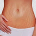 4 Cara Alami dan Efektif Menghilangkan Stretch Mark