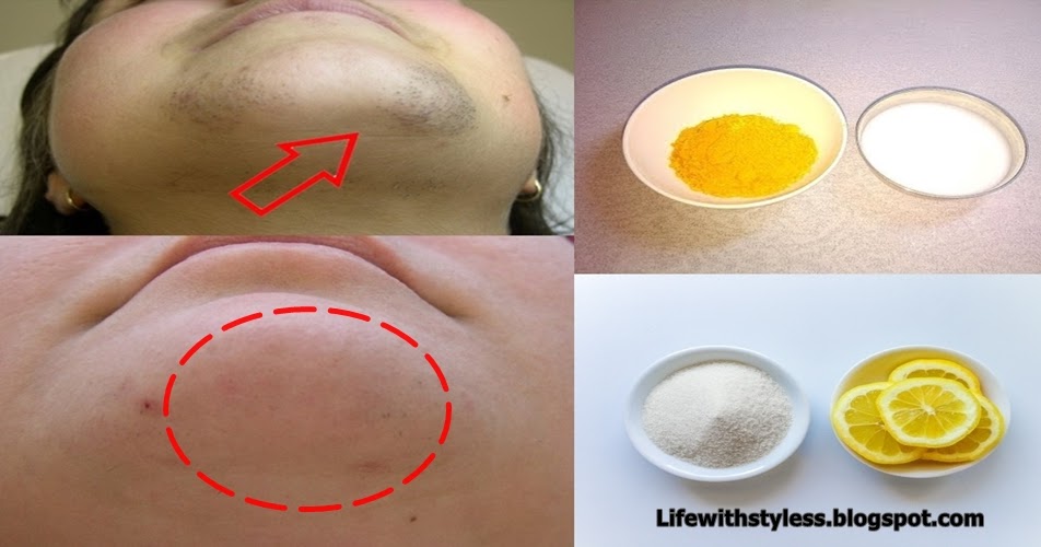 Want Remedies for removing facial hair only