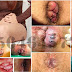 Cari Obat Wasir Ambeien Yang Bagus di Apotik thumbnail