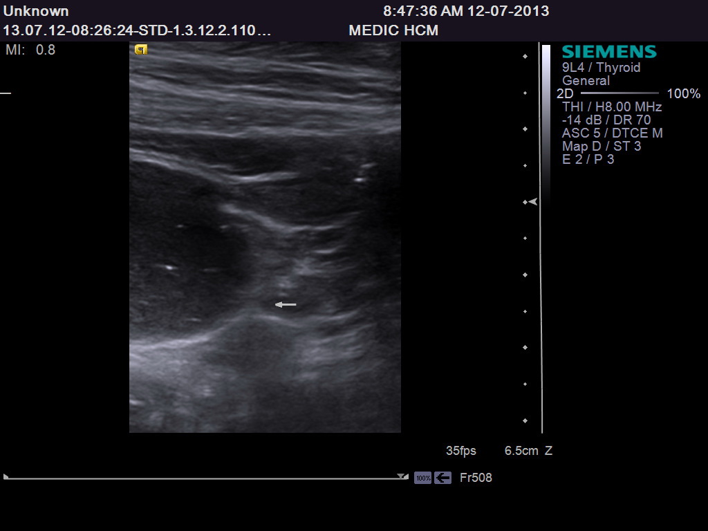 Appendiceal orifice (arrow) and water filled cecum.