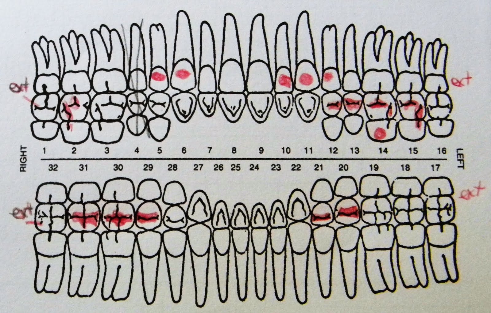 tooth 13