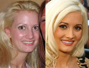 Jessica Simpson Plastic Surgery