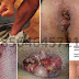 Produk Herbal Obat Wasir Berdarah Segar thumbnail