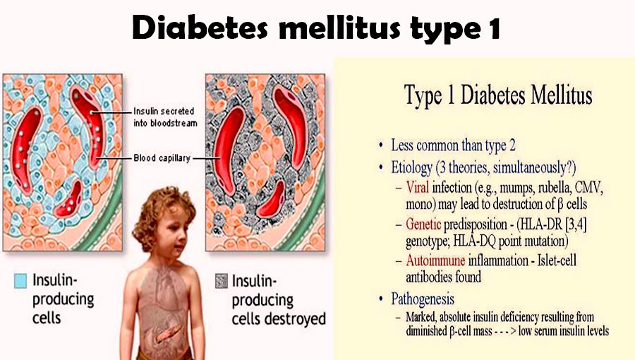 Diabetes type 1 essay