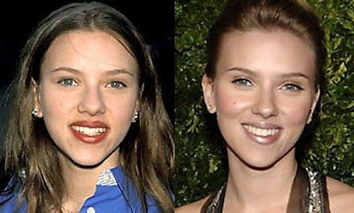 Megan Fox plastic surgery
