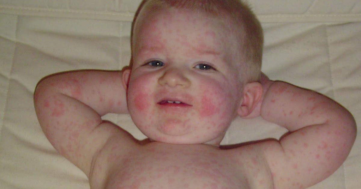 Healthtalk Fifth Disease or Erythema Infectiosum