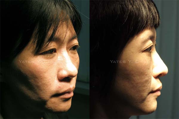 微晶瓷注射隆鼻, Radiesse nose augmentation 微晶瓷注射隆鼻, Radiesse nose augmentation, 趙彥宇