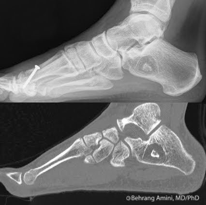 Roentgen Ray Reader: Calcaneal Intraosseous Lipoma