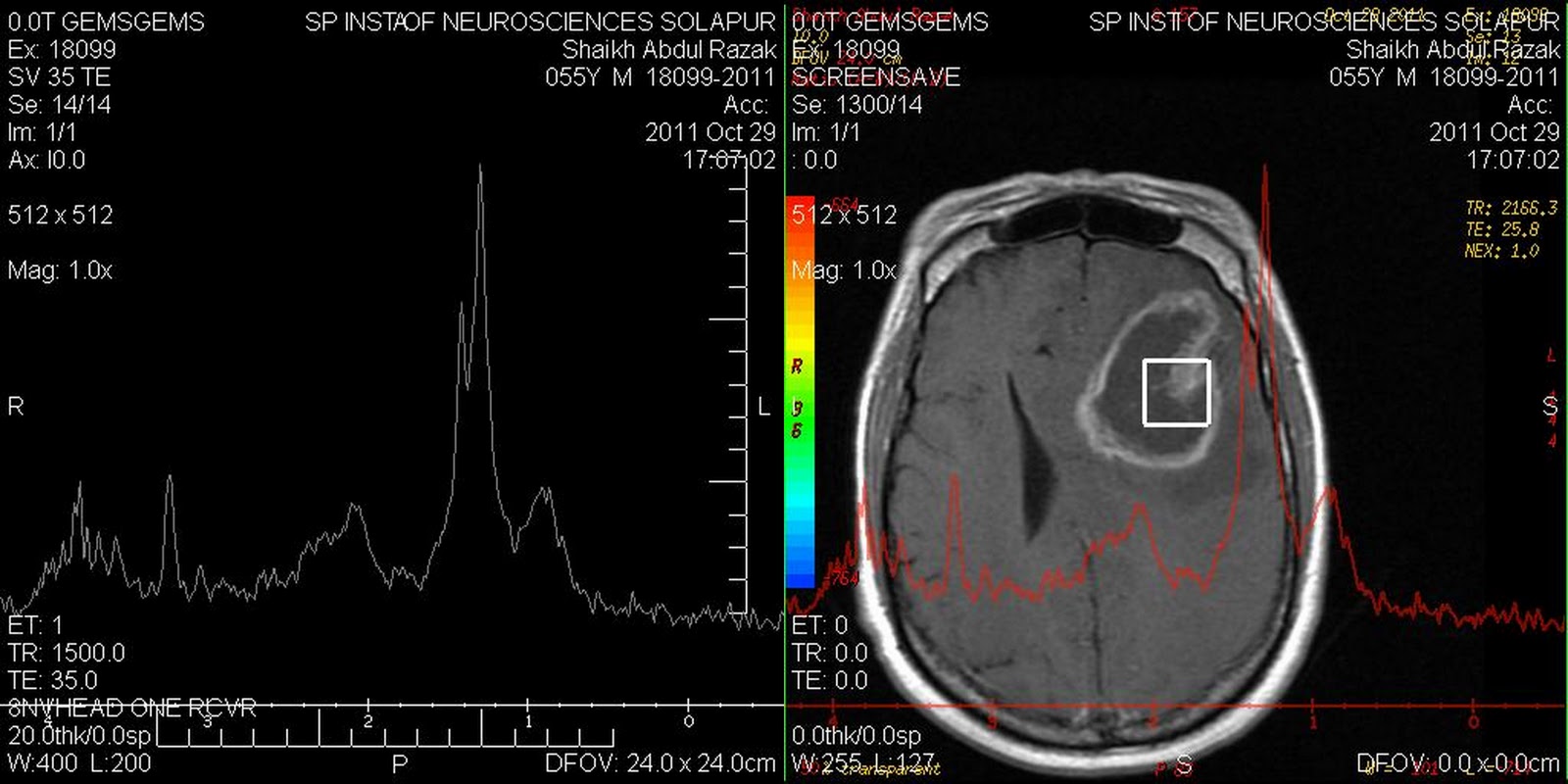 Dr Balaji Anvekar FRCR Glioblastoma multiforme