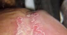 Balanite du gland traitement naturel