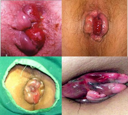 obat wasir utk ibu menyusui, obat ambeien wasir untuk ibu hamil, obat herbal mujarab untuk wasir