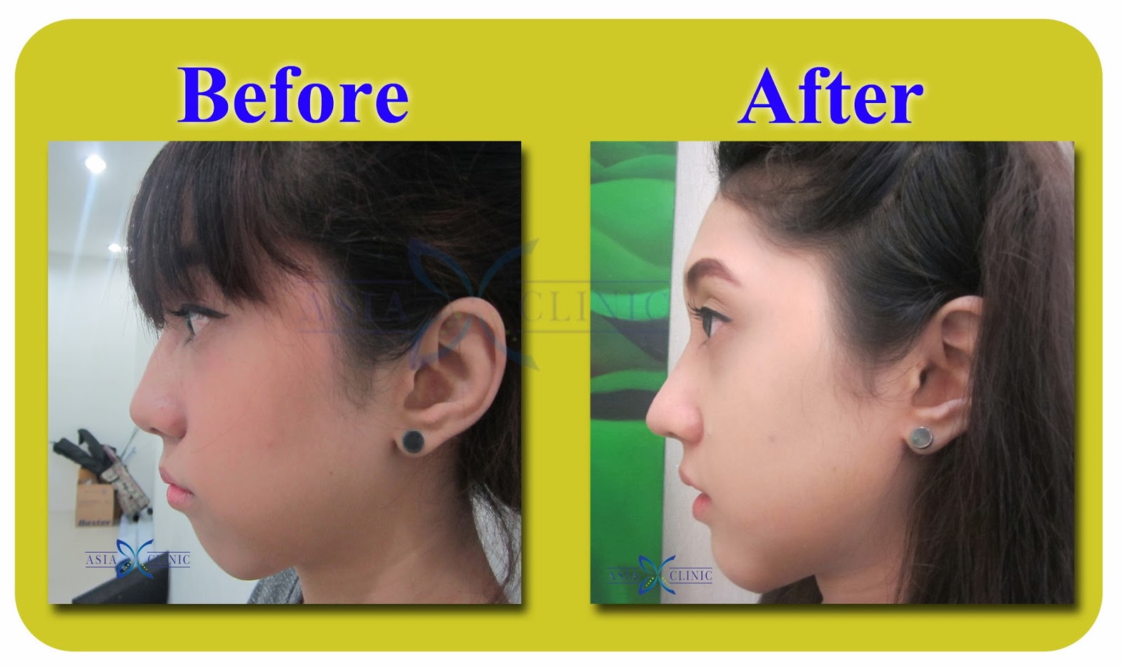 Rhinoplasty Surgery Thailand Nose Augmentation Before And After Photos