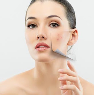 Tips Cara Menghilangkan Jerawat Secara Alami Tips Cara Menghilangkan Jerawat Secara Alami