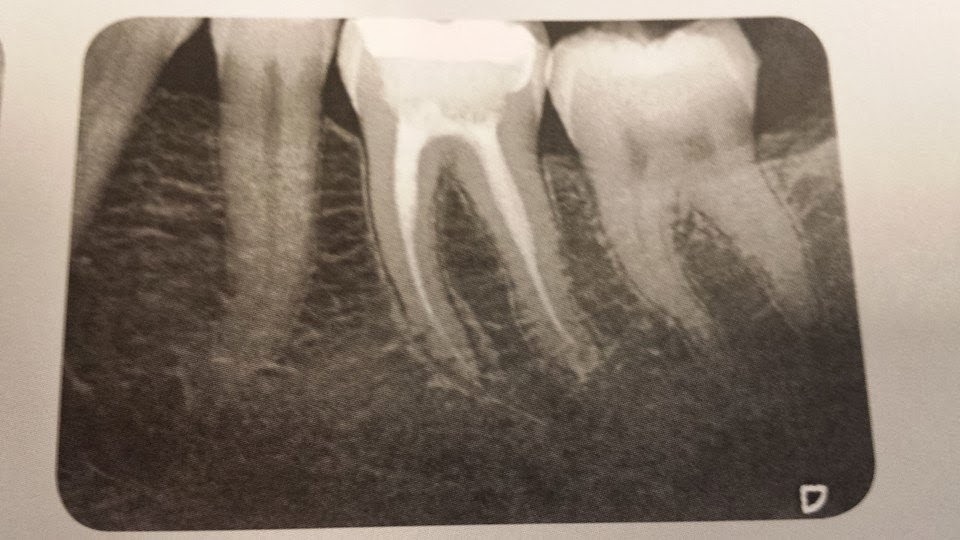 Root Canal Treatment Bellevue Family Dentistry Root Canal Treatment Bellevue Family Dentistry